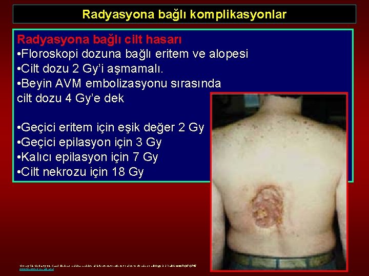 Radyasyona bağlı komplikasyonlar Radyasyona bağlı cilt hasarı • Floroskopi dozuna bağlı eritem ve alopesi