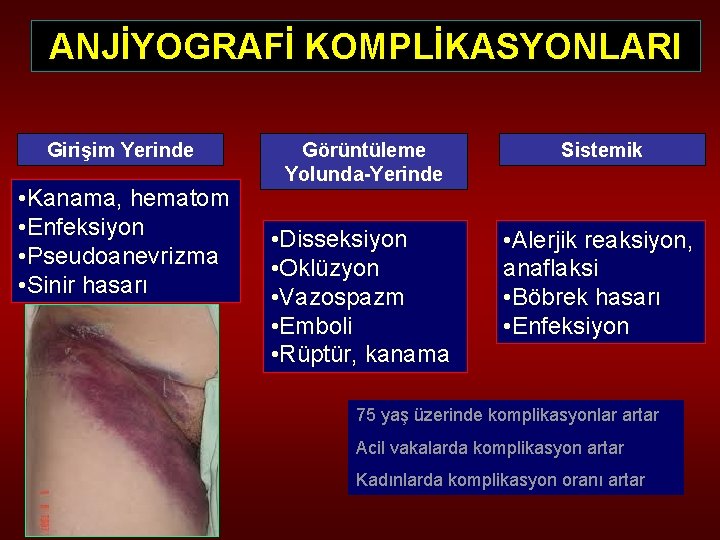 ANJİYOGRAFİ KOMPLİKASYONLARI Girişim Yerinde • Kanama, hematom • Enfeksiyon • Pseudoanevrizma • Sinir hasarı