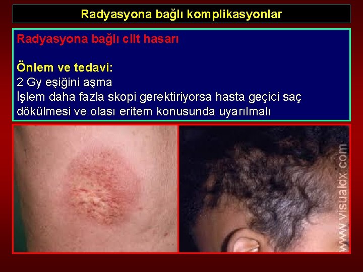 Radyasyona bağlı komplikasyonlar Radyasyona bağlı cilt hasarı Önlem ve tedavi: 2 Gy eşiğini aşma