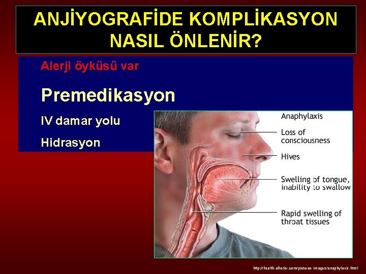 ANJİYOGRAFİDE KOMPLİKASYON NASIL ÖNLENİR? Alerji öyküsü var Premedikasyon IV damar yolu Hidrasyon http: //health.