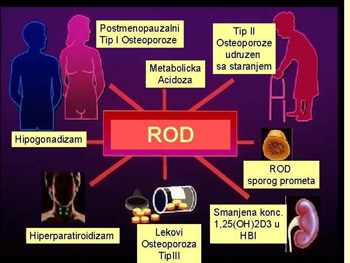 Postmenopauzalni Tip I Osteoporoze Metabolicka Acidoza Hipogonadizam Tip II Osteoporoze udruzen sa staranjem ROD