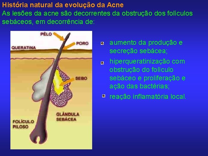 História natural da evolução da Acne As lesões da acne são decorrentes da obstrução