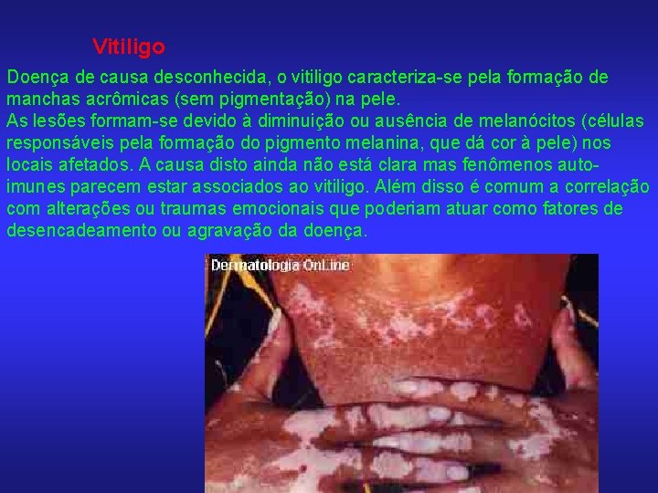 Vitiligo Doença de causa desconhecida, o vitiligo caracteriza-se pela formação de manchas acrômicas (sem