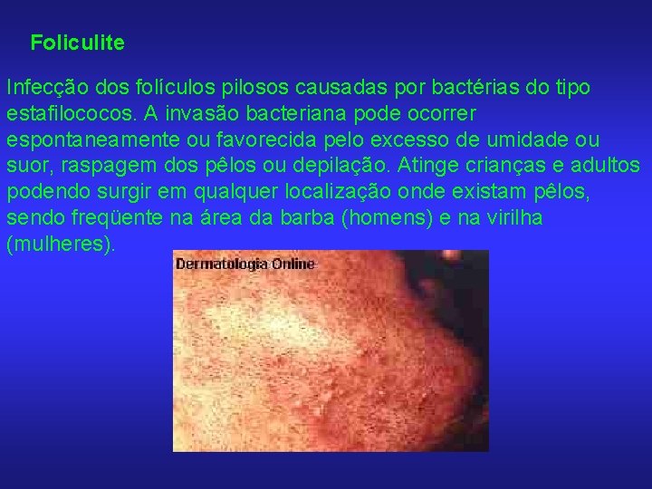 Foliculite Infecção dos folículos pilosos causadas por bactérias do tipo estafilococos. A invasão bacteriana