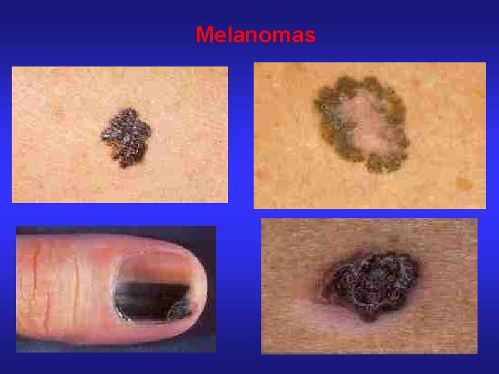 Melanomas 