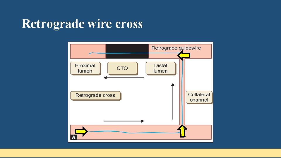 Retrograde wire cross 
