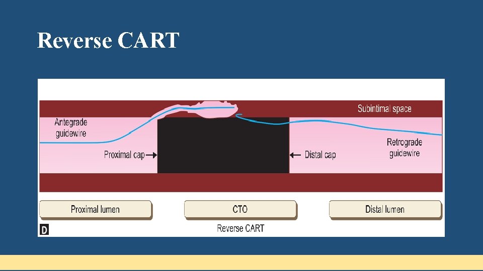 Reverse CART 