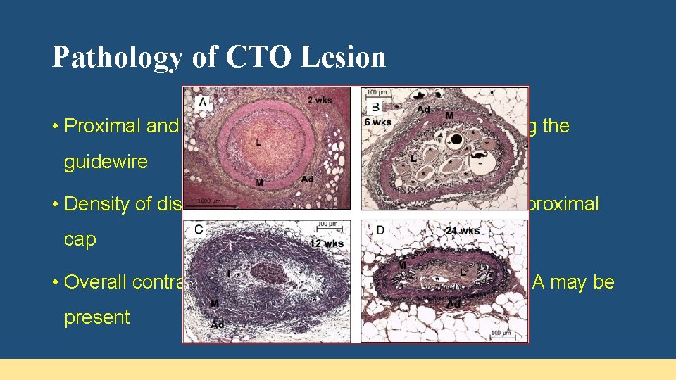 Pathology of CTO Lesion • Proximal and distal fibrous caps act as barriers forcing