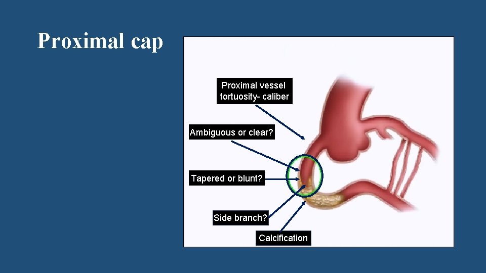 Proximal cap Proximal vessel tortuosity- caliber Ambiguous or clear? Tapered or blunt? Side branch?