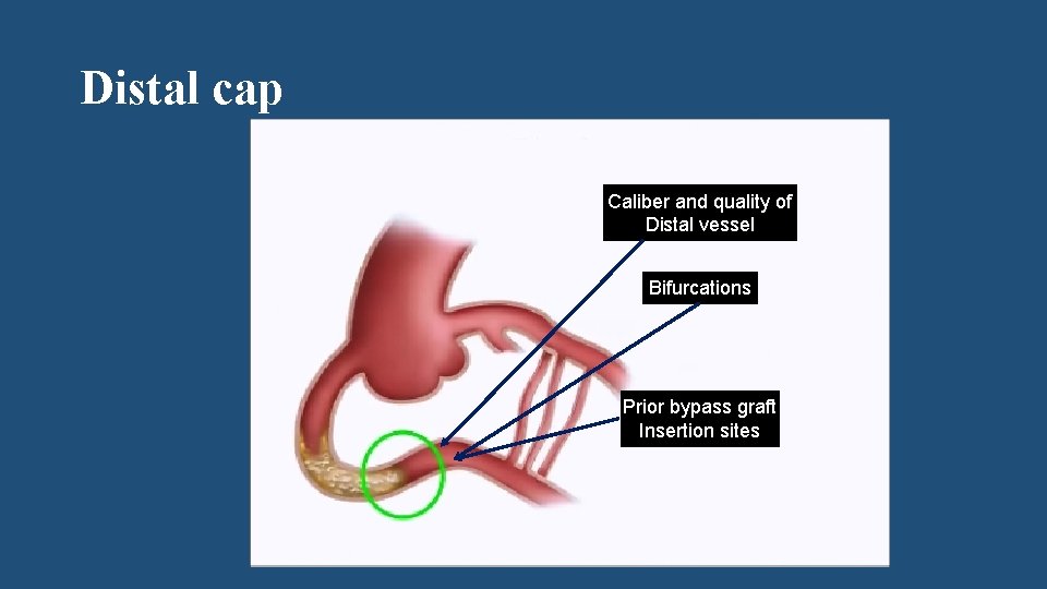 Distal cap Caliber and quality of Distal vessel Bifurcations Prior bypass graft Insertion sites