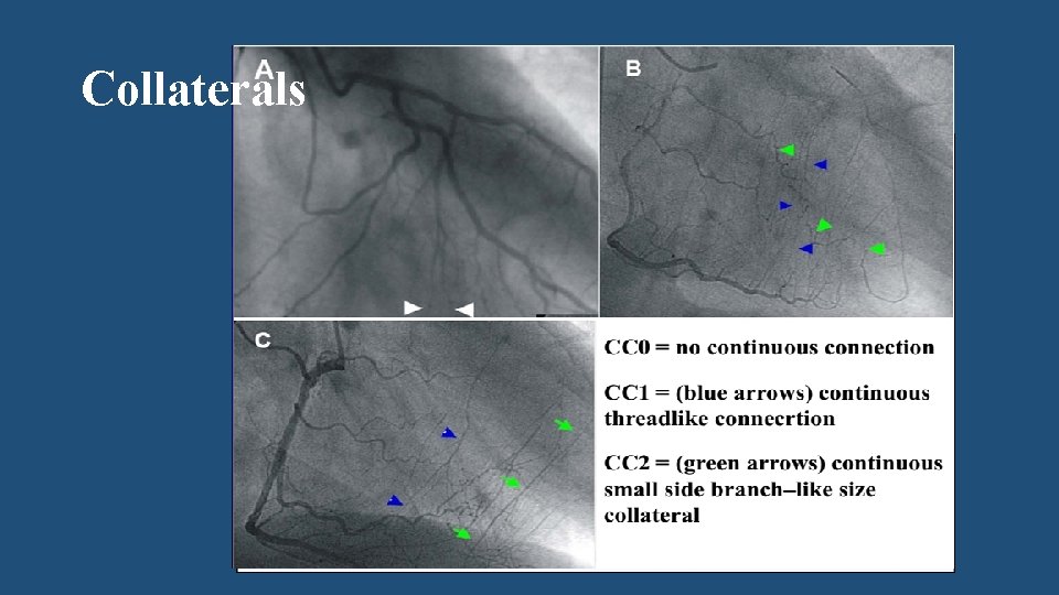 Collaterals Type- Septal, bypass graft, epicardial Size- Werner Classification Tortuosity Dominance Angle and location