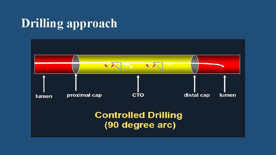 Drilling approach 