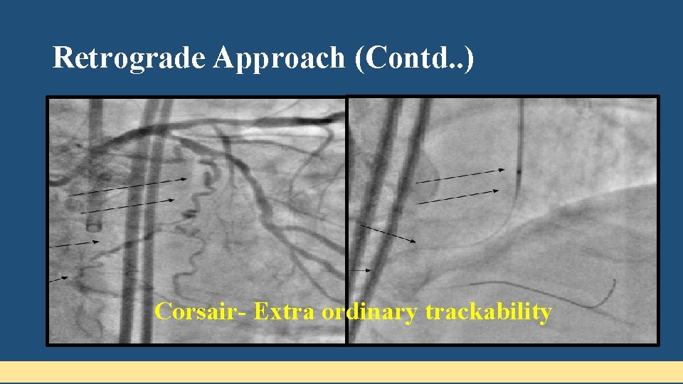 Retrograde Approach (Contd. . ) • Hydrophilic soft-tipped floppy guidewires are ideal for negotiating