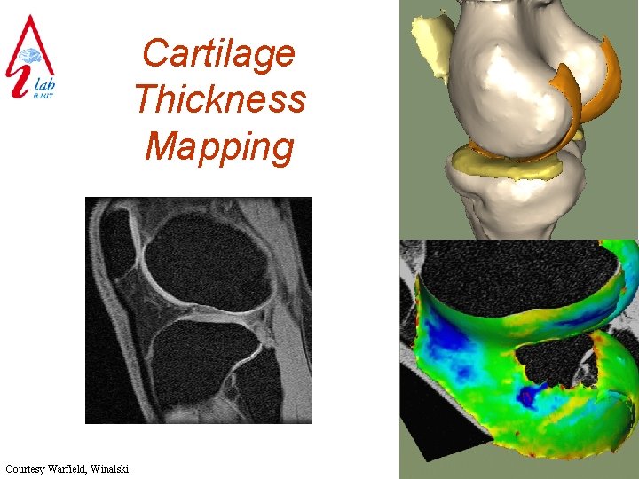 Cartilage Thickness Mapping Courtesy Warfield, Winalski 