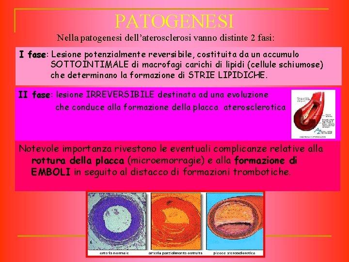 PATOGENESI Nella patogenesi dell’aterosclerosi vanno distinte 2 fasi: I fase: fase Lesione potenzialmente reversibile,