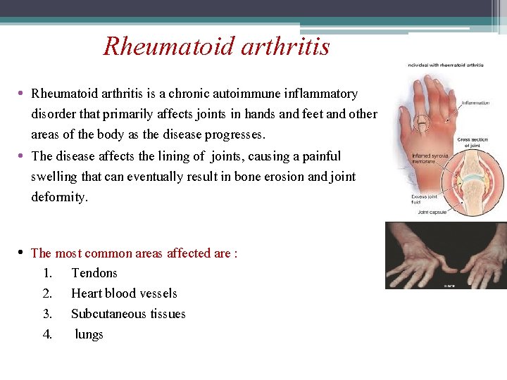 Rheumatoid arthritis • Rheumatoid arthritis is a chronic autoimmune inflammatory disorder that primarily affects