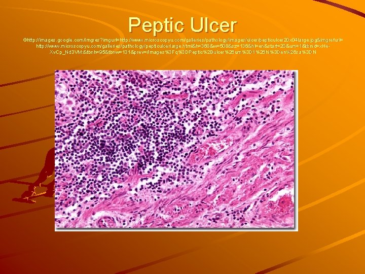 Peptic Ulcer ©http: //images. google. com/imgres? imgurl=http: //www. microscopyu. com/galleries/pathology/images/ulcer/pepticulcer 20 x 04 large.