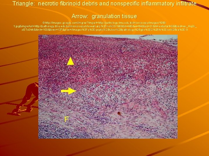 Triangle: necrotic fibrinoid debris and nonspecific inflammatory infiltrate Arrow: granulation tissue ©http: //images. google.
