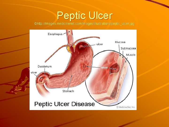 Peptic Ulcer ©http: //images. medicinenet. com/images/illustrations/peptic_ulcer. jpg 