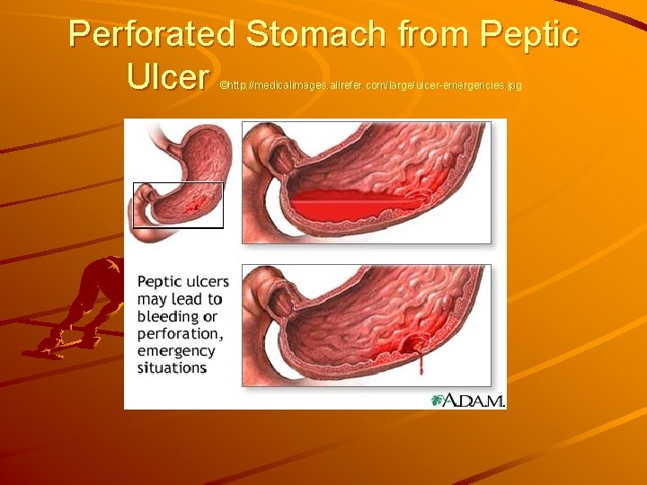 Perforated Stomach from Peptic Ulcer ©http: //medicalimages. allrefer. com/large/ulcer-emergencies. jpg 