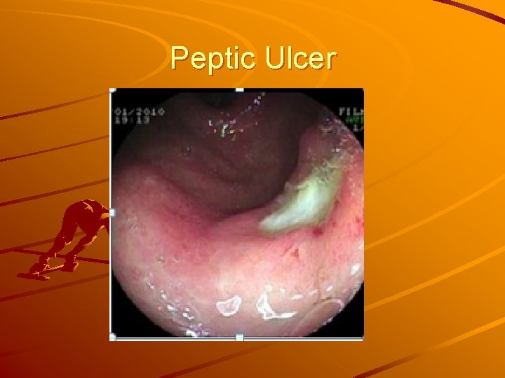 Peptic Ulcer 