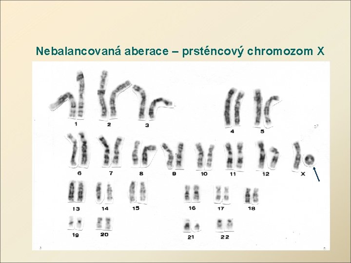 Nebalancovaná aberace – prsténcový chromozom X 