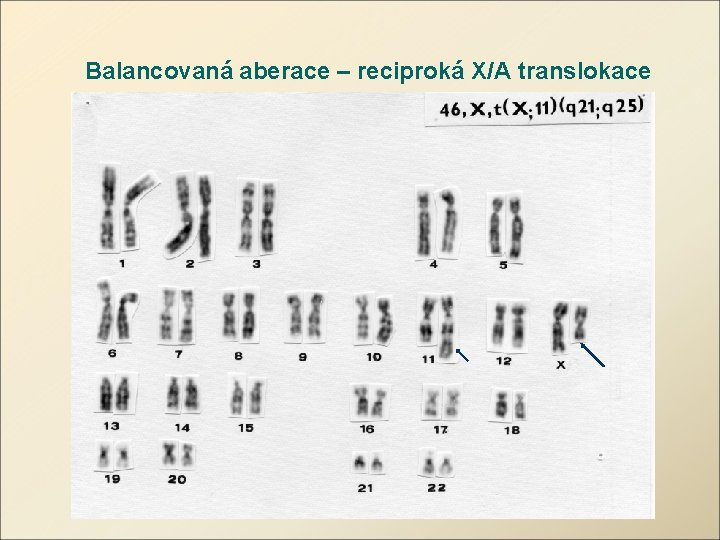 Balancovaná aberace – reciproká X/A translokace 