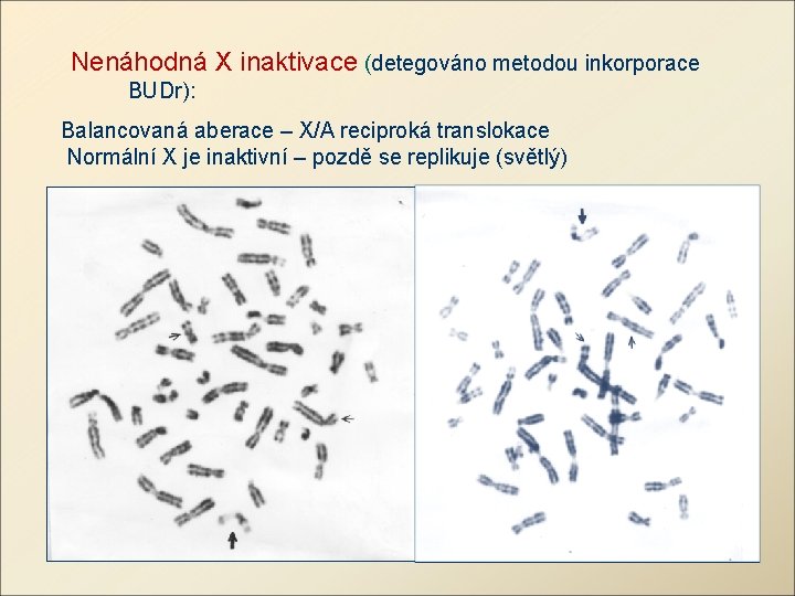  Nenáhodná X inaktivace (detegováno metodou inkorporace BUDr): Balancovaná aberace – X/A reciproká translokace