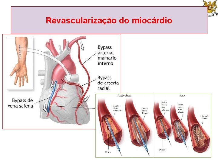 Revascularização do miocárdio 