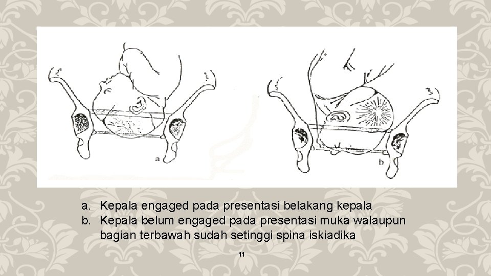 a. Kepala engaged pada presentasi belakang kepala b. Kepala belum engaged pada presentasi muka