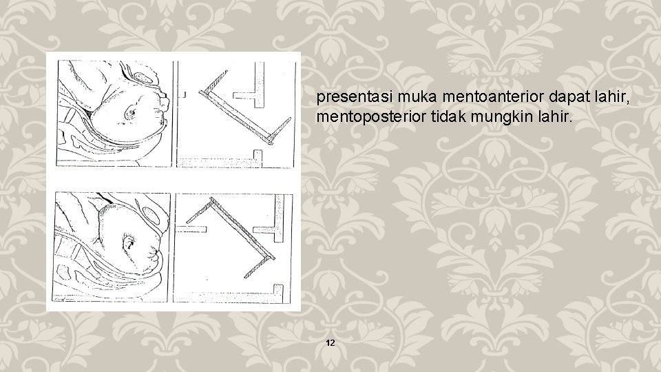 presentasi muka mentoanterior dapat lahir, mentoposterior tidak mungkin lahir. 12 