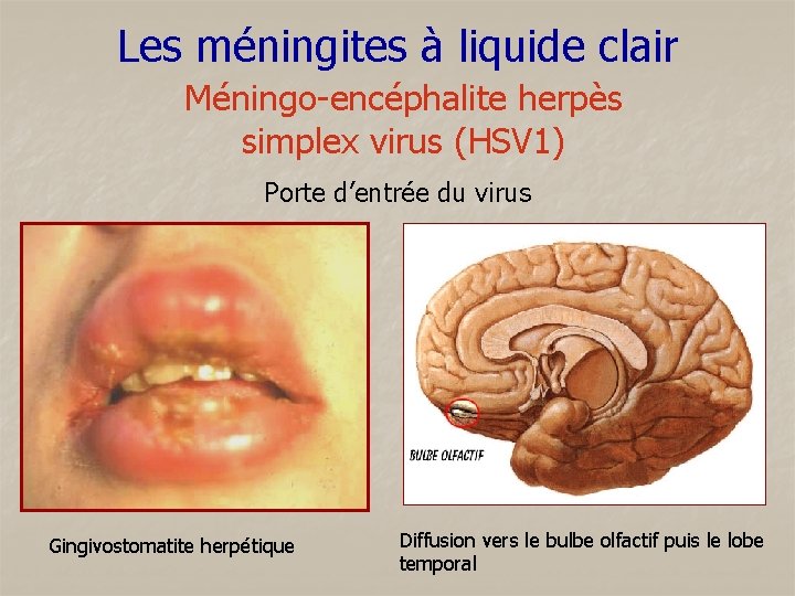 Les méningites à liquide clair Méningo-encéphalite herpès simplex virus (HSV 1) Porte d’entrée du