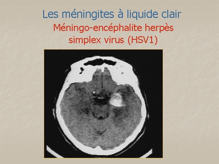 Les méningites à liquide clair Méningo-encéphalite herpès simplex virus (HSV 1) 