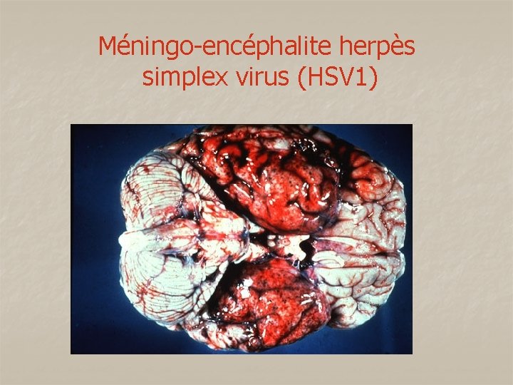 Méningo-encéphalite herpès simplex virus (HSV 1) 