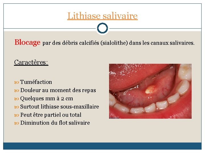 Lithiase salivaire Blocage par des débris calcifiés (sialolithe) dans les canaux salivaires. Caractères: Tuméfaction