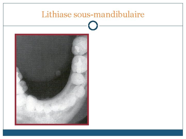 Lithiase sous-mandibulaire 