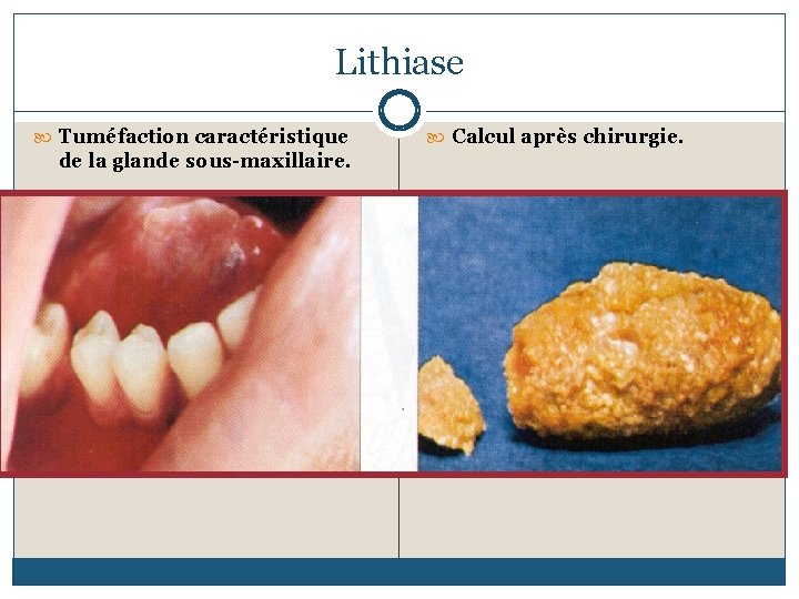 Lithiase Tuméfaction caractéristique de la glande sous-maxillaire. Calcul après chirurgie. 