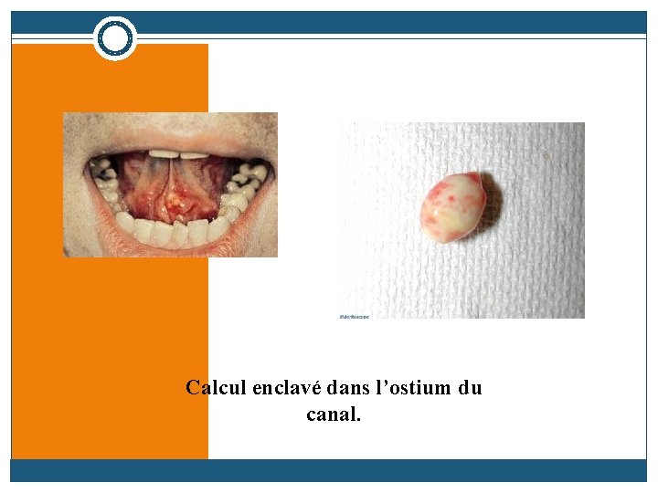 Calcul enclavé dans l’ostium du canal. 