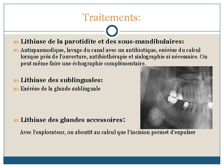 Traitements: Lithiase de la parotidite et des sous-mandibulaires: Antispasmodique, lavage du canal avec un
