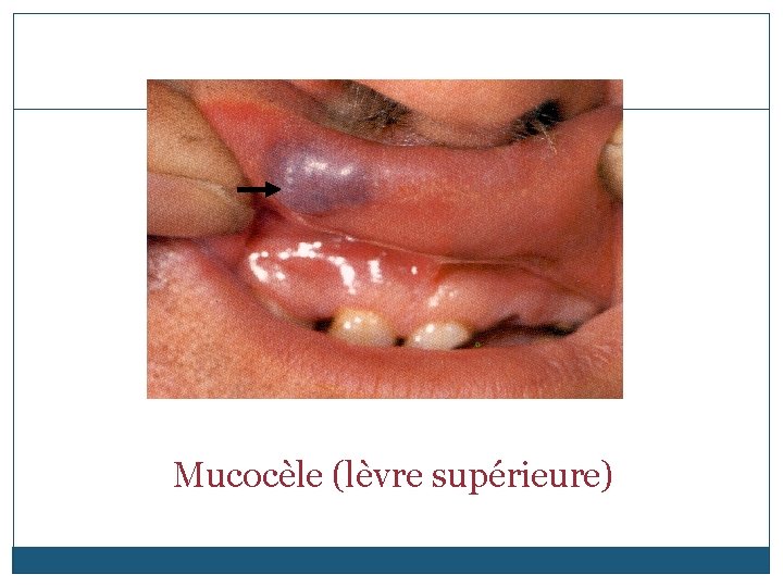 Mucocèle (lèvre supérieure) 