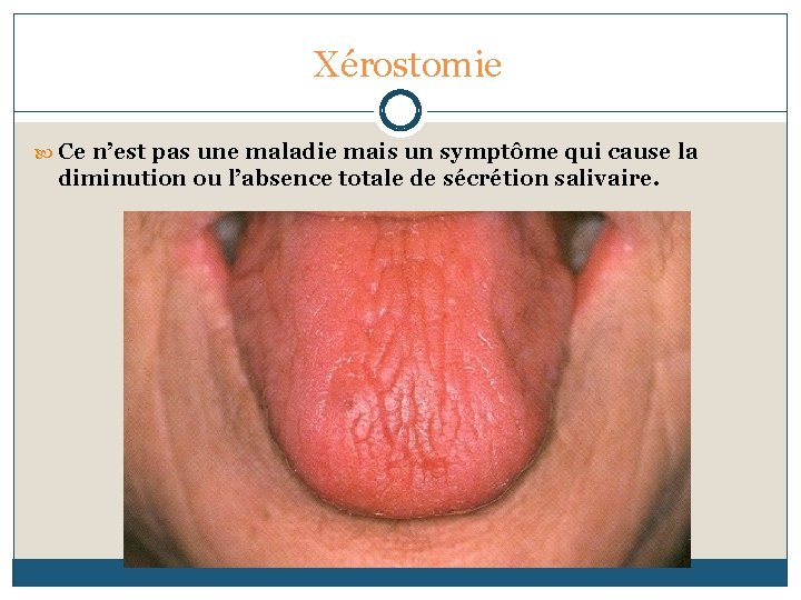 Xérostomie Ce n’est pas une maladie mais un symptôme qui cause la diminution ou