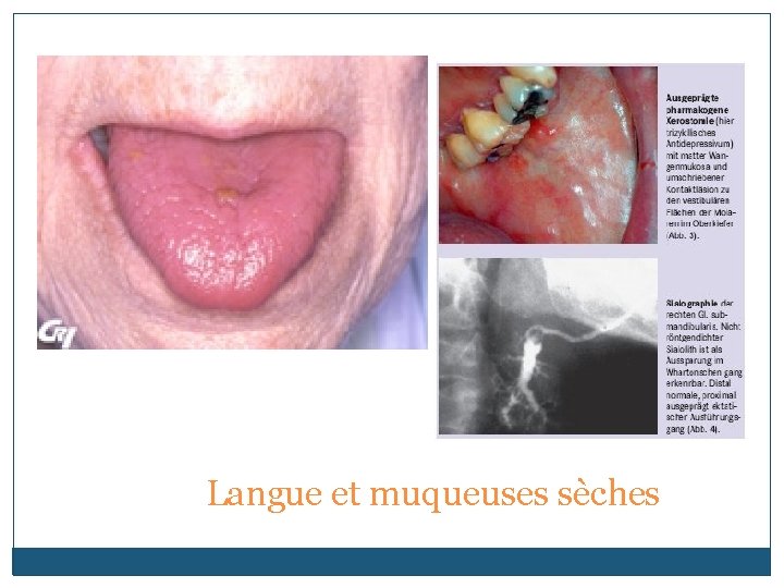 Langue et muqueuses sèches 