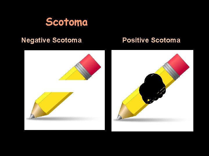 Scotoma Negative Scotoma Positive Scotoma 