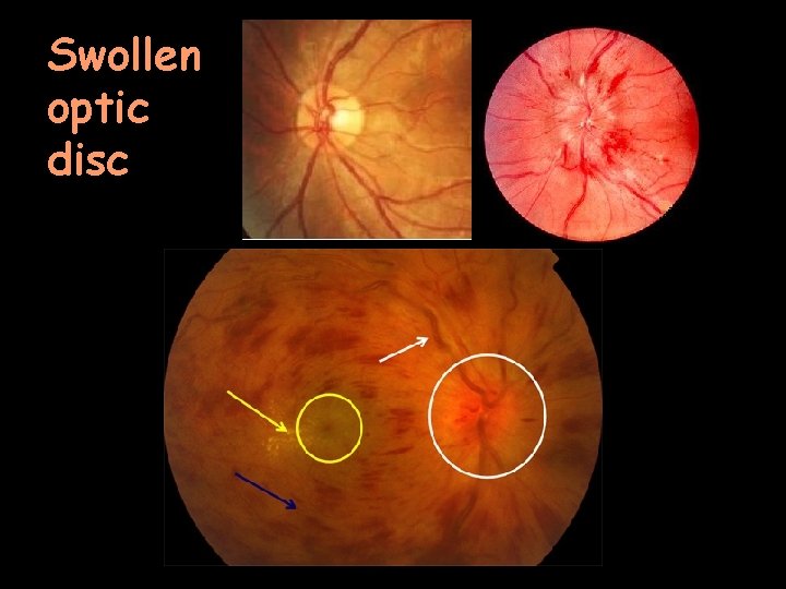 Swollen optic disc 