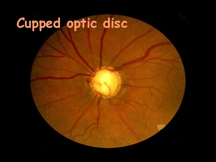 Cupped optic disc 