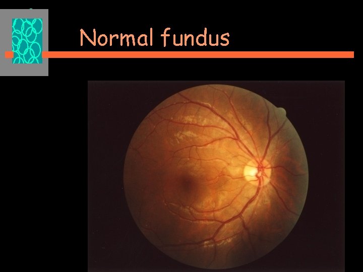 Normal fundus 