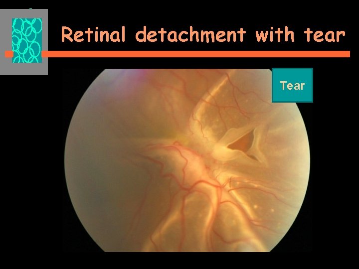 Retinal detachment with tear Tear 
