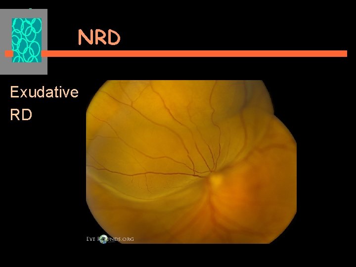 NRD Exudative RD 