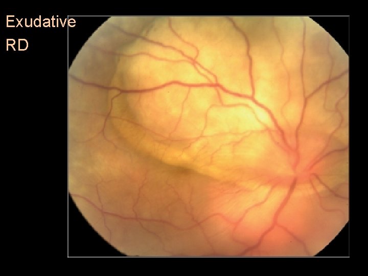 Exudative RD 