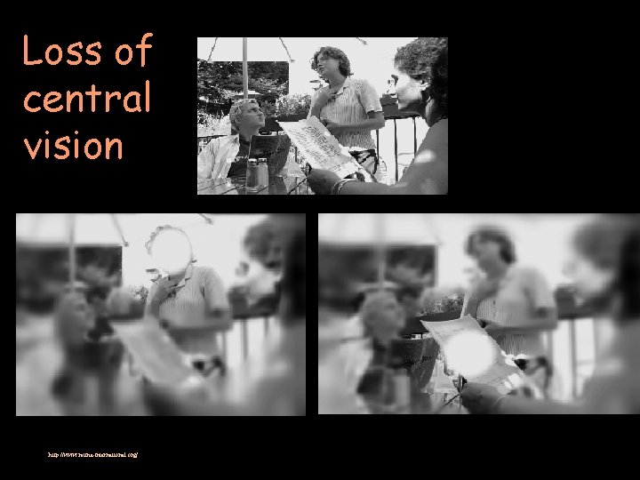 Loss of central vision http: //www. retina-international. org/ 
